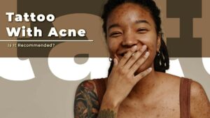 Tattoo With Acne: Is It Recommended?