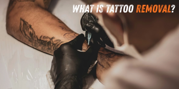 What is Tattoo Removal — Hardwork Tattoo Brampton