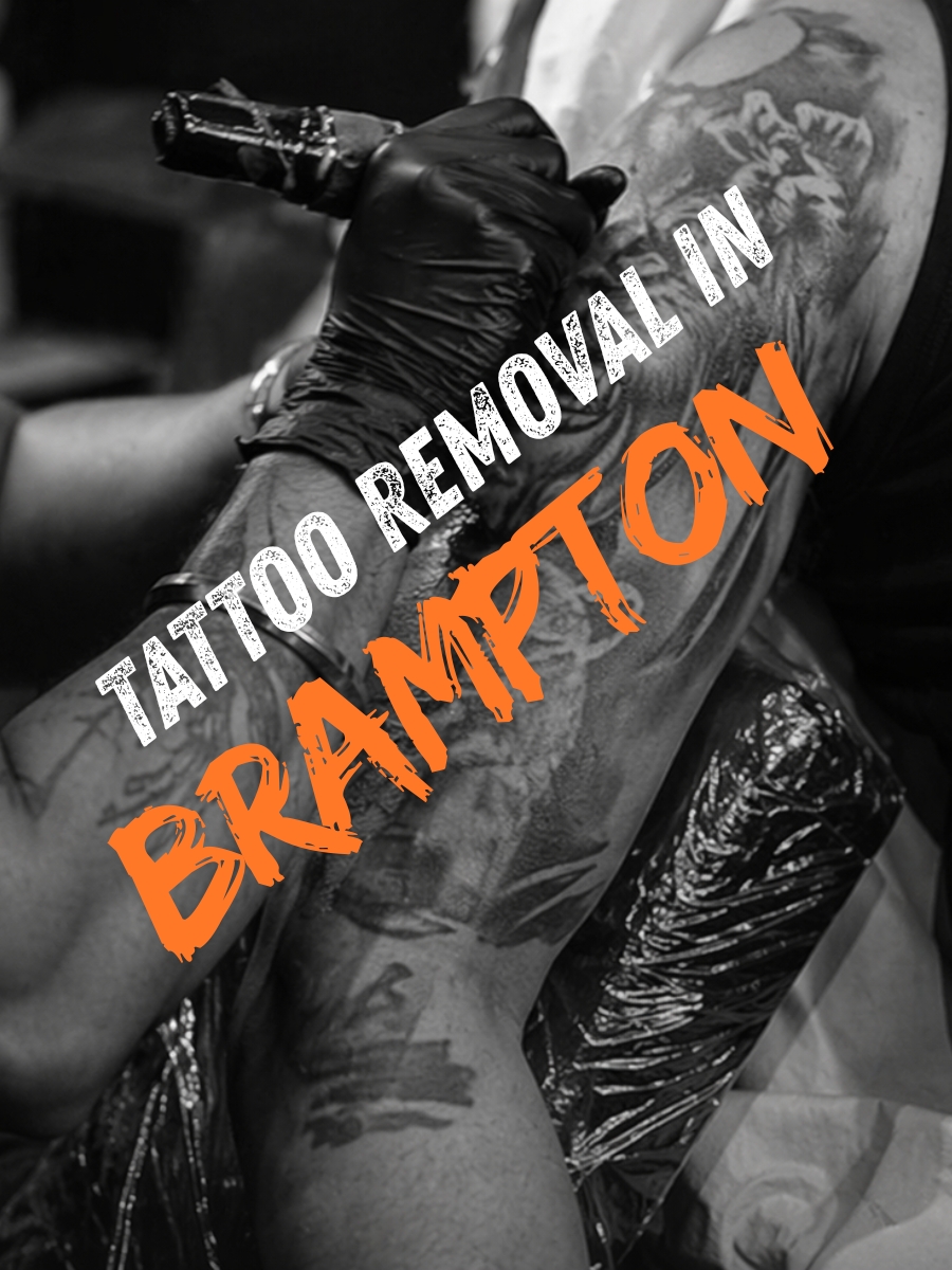 Tattoo Removal in Brampton — Hardwork Tattoo